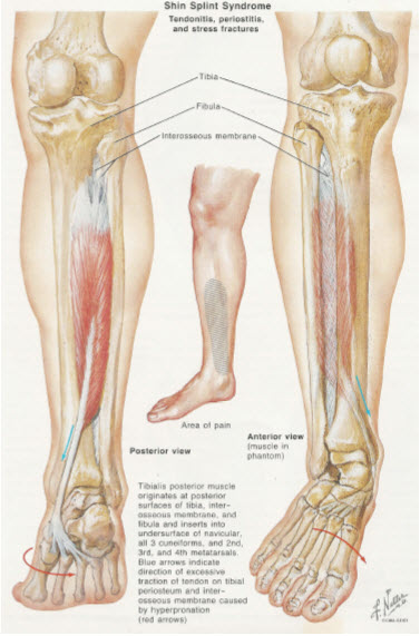 Medial Stress Syndrome