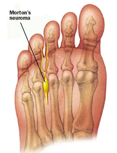 Painful Morton's neuroma in Houston