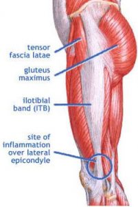 Iliotabial Band Syndrome