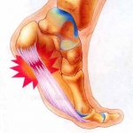 Plantar Fasciitis