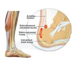 Achilles Bursitis