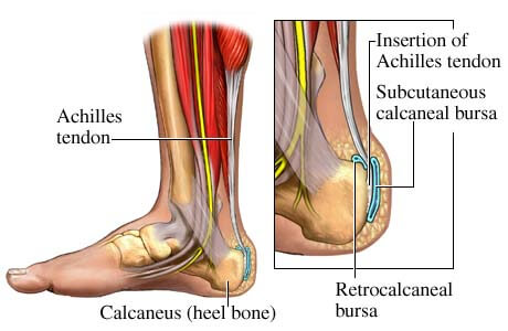 achilles tendon running injury