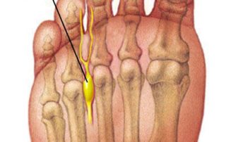 Mortons Neuroma