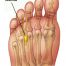 Mortons Neuroma