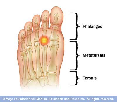 Ball of Foot Pain