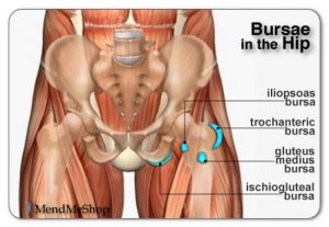 Ischial Bursitis (Courtesy of MendMeShop)