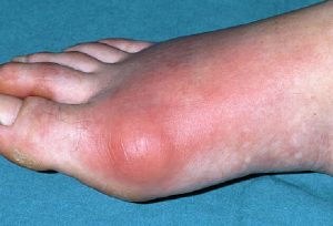 SDRI-gout-toe