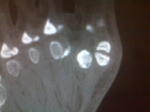 SDRI-xray-of-bi-partite-sesamoid-bones