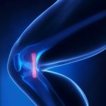 Most MCL sprains can be fixed without surgery