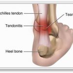 Achilles tendons can suffer microtears and become tendonosis and painful
