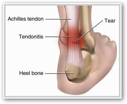 achilles tendon running injury