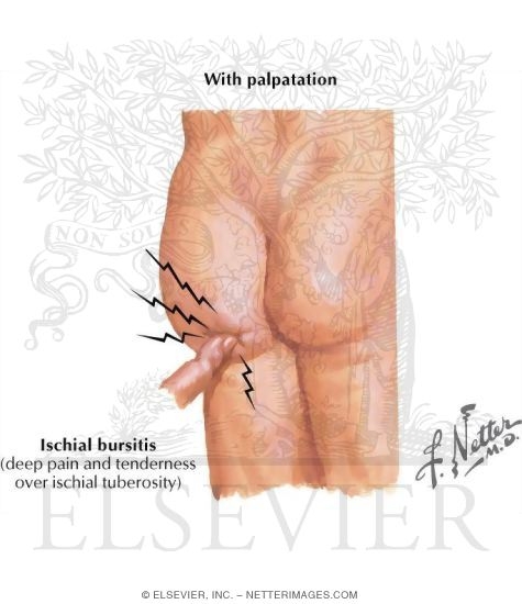 Ischial Bursitis  Rehab My Patient