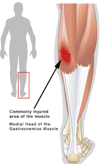 Calf Tear - Tennis Leg