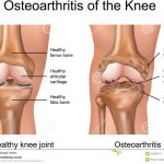 Running DOES NOT cause Knee arthritis!