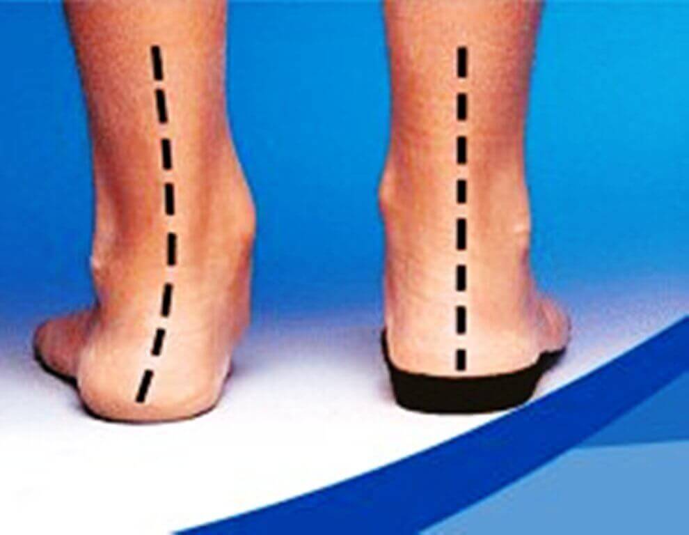 rigid orthotics for overpronation