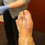 post foot surgery