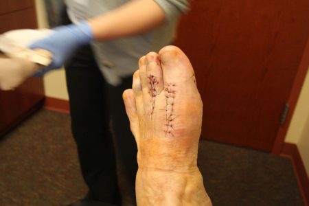 foot surgery for plantar plate tears