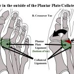 collateral ligament tear toe