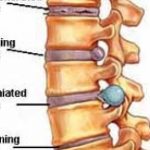 disc swelling can put pressure on your nerves