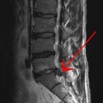 MRI showing L5 Disc Bulge