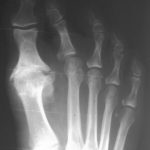 2nd toe is deviating towards big toe due to ligament tear