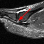 Plantar Plates are very small and small tears are easy to miss even by excellent radiologist