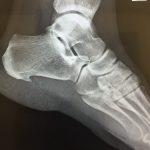 Notice the spur growing on the heel or Calcaneus