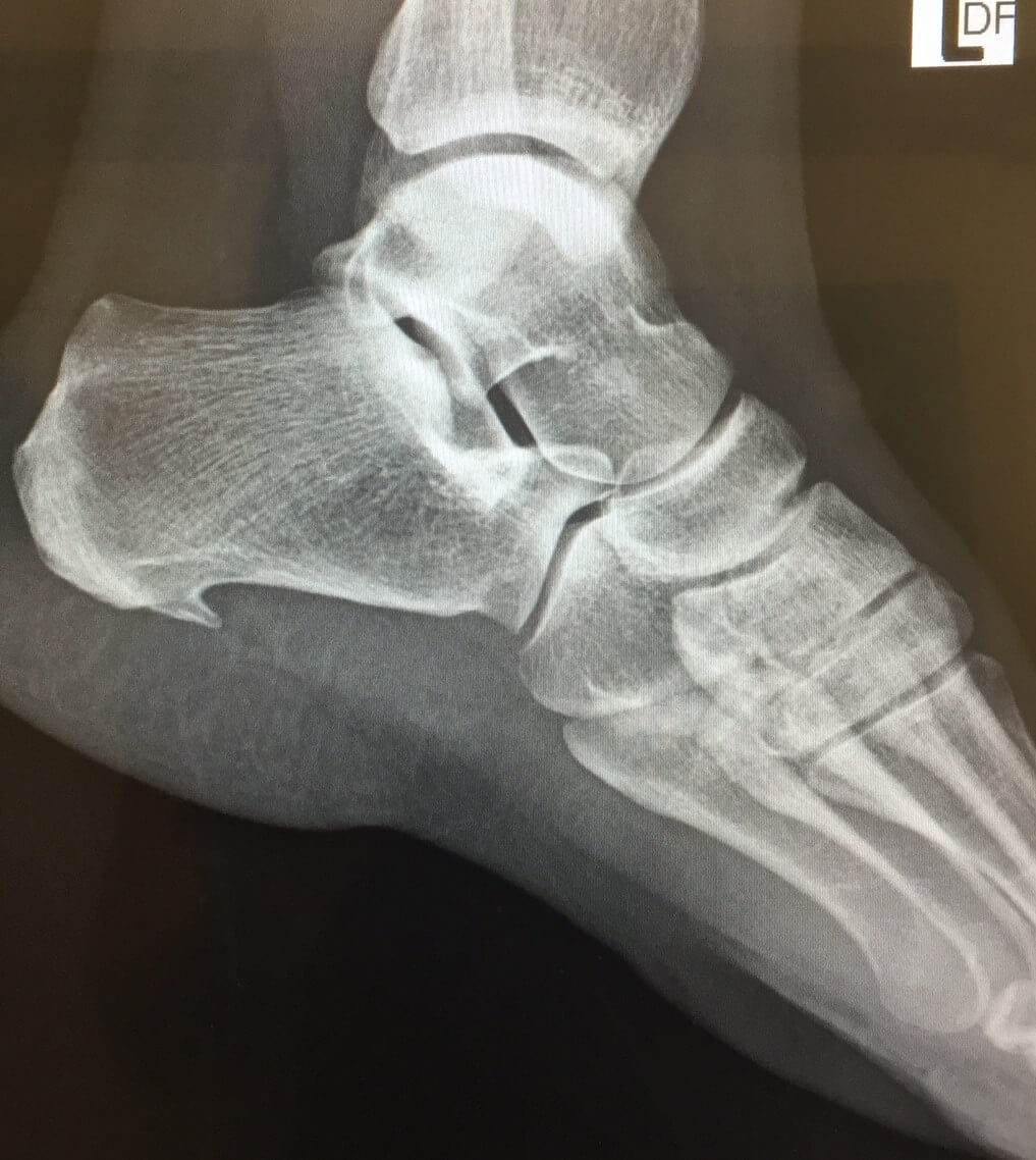 Do you see the spur growing on the heel or Calcaneus