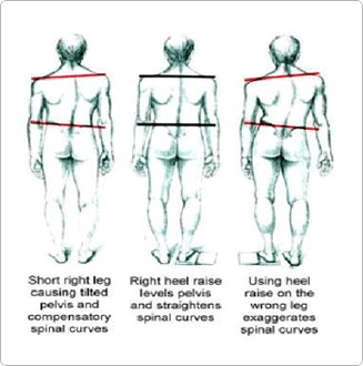 leg length discrepancy