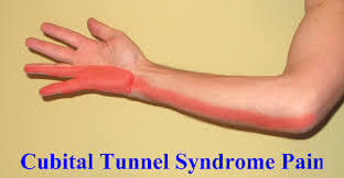 Nerve irritation at the elbow can cause symptoms along the entire nerve