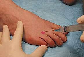 cortisone for metatarsalgia