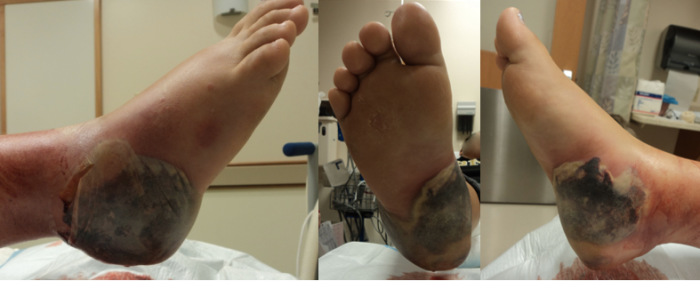 Surgery is not typically necessary to fix my heel pain
