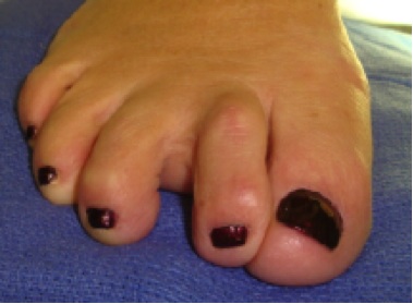 Deviated toe is a sign of a plantar plate injury