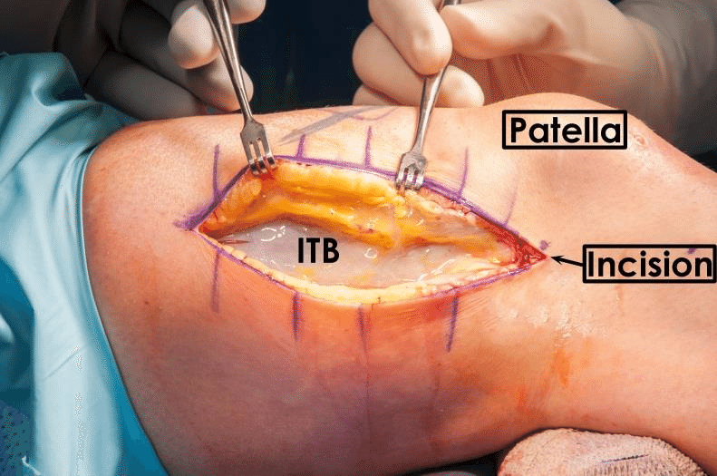 Surgery is not usually necessary to fix Iliotibial Band Syndrome