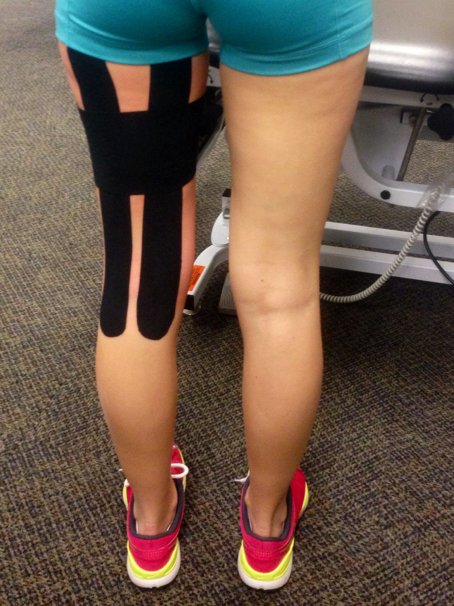 Taping can be effective but a brace provides more compression and is easier to use